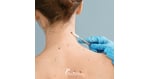 Melanoma That Has Spread Beyond the Skin: Advanced Treatment Options in Mexico