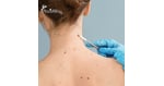 Advanced Melanoma Treatment in Tijuana - Targeting Metastasis When Standard Care Fails