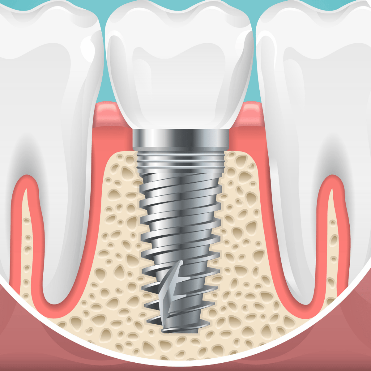 Implantes dentales asequibles en Costa Rica: ahorre hasta un 60%