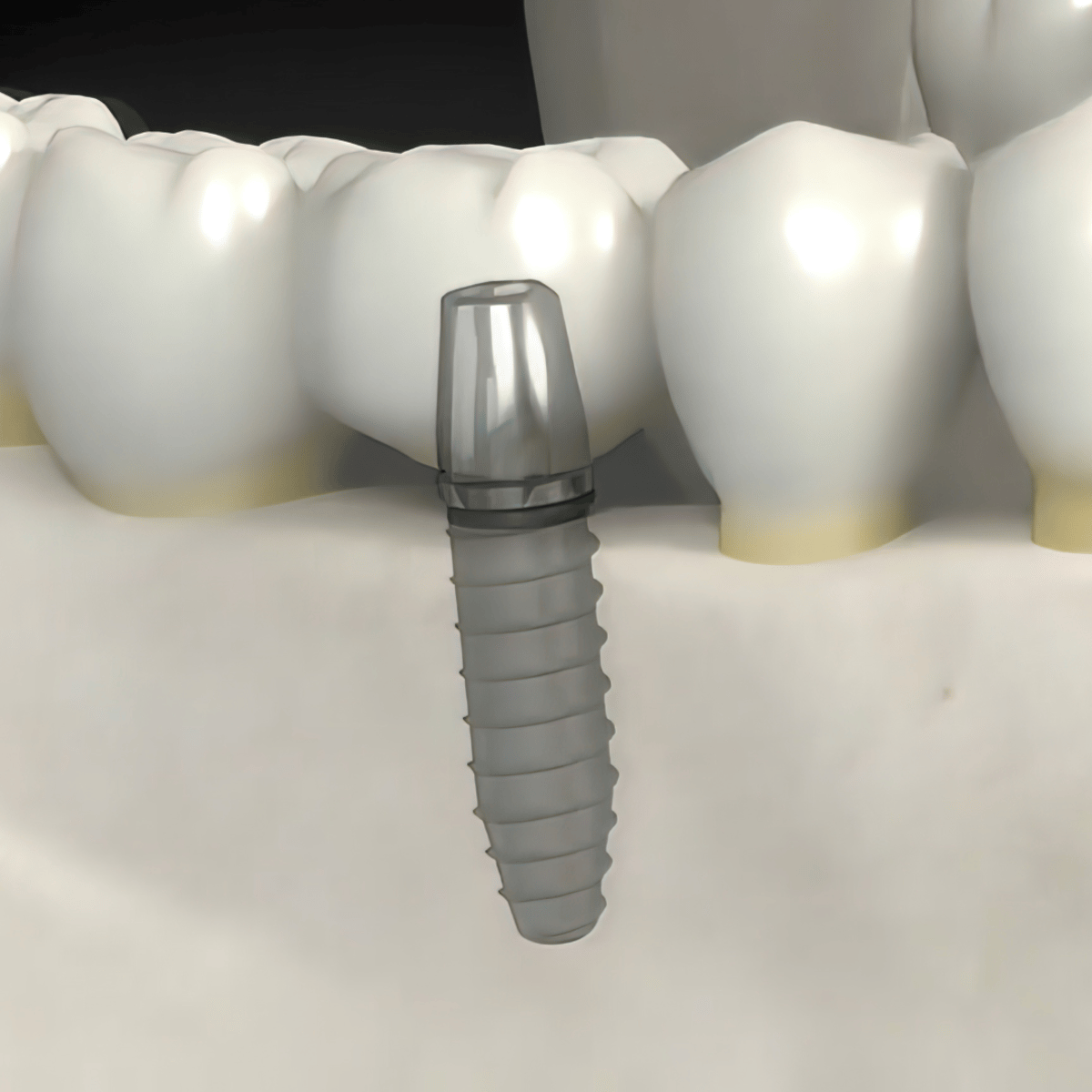 All on 4 Dental Implants in Mexico - 4 Tips for Tourists