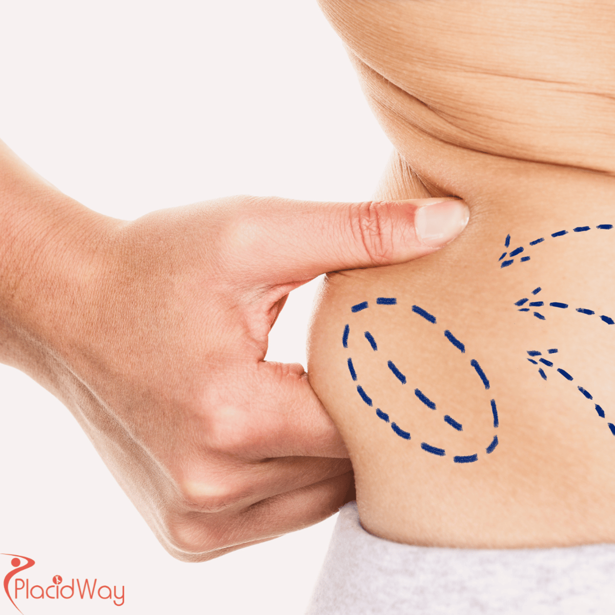 Liposucción 12345 en Colombia: ¿Por qué pacientes de EE. UU. y Canadá eligen Bogotá y Medellín para la remodelación corporal?