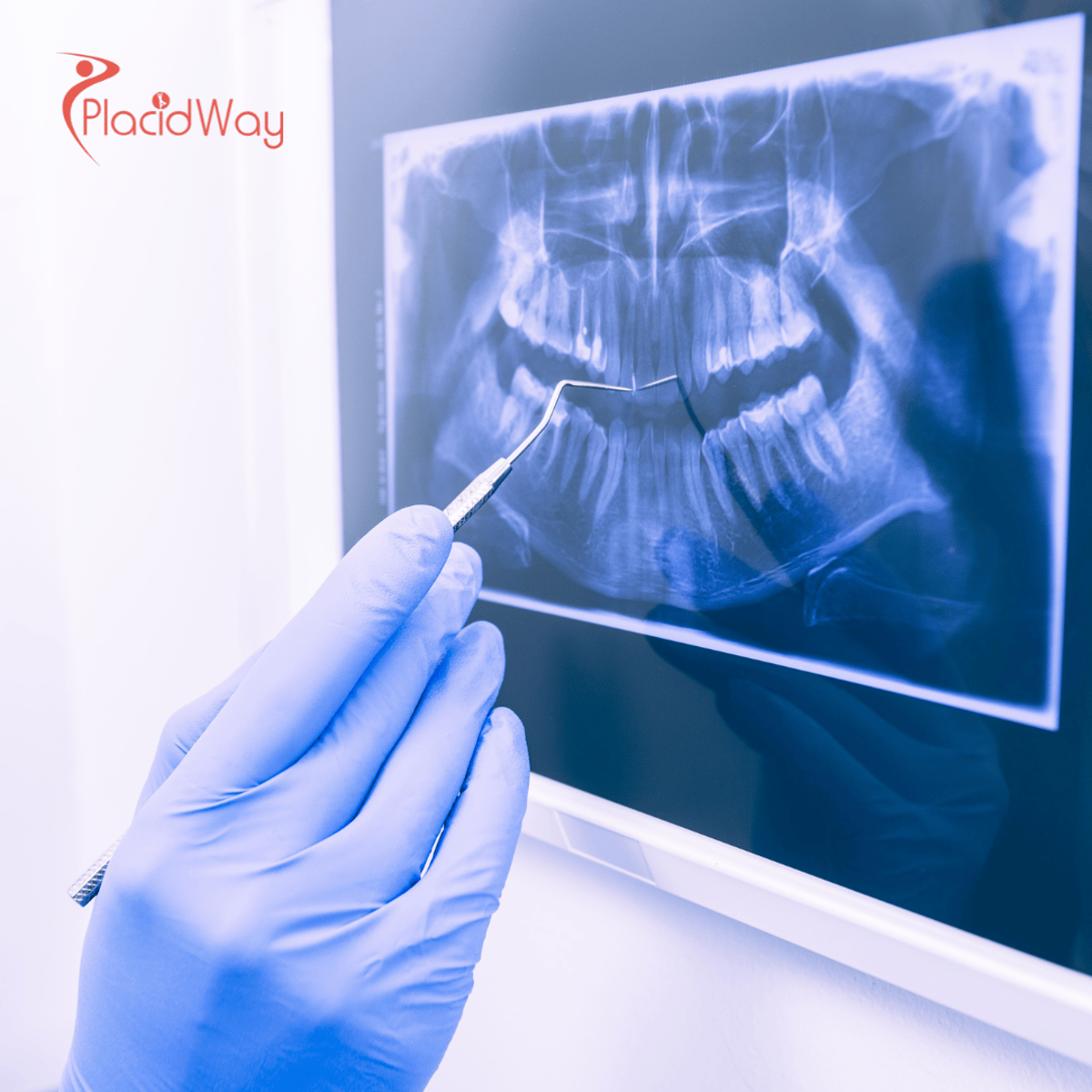 澳大利亚人在越南接受的顶级牙科手术：All-on-4 种植牙引领潮流