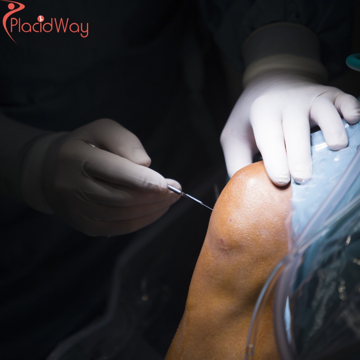 Affordable Stem Cell Therapy for Knee Injuries in Costa Rica: A Viable Option for Canadian Patients