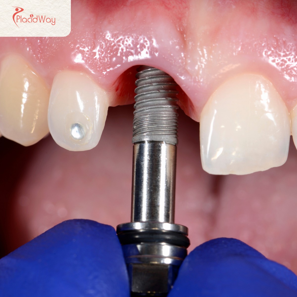 All-on-4 Dental Implants in Turkey: A Full Mouth Restoration Guide for UK Patients
