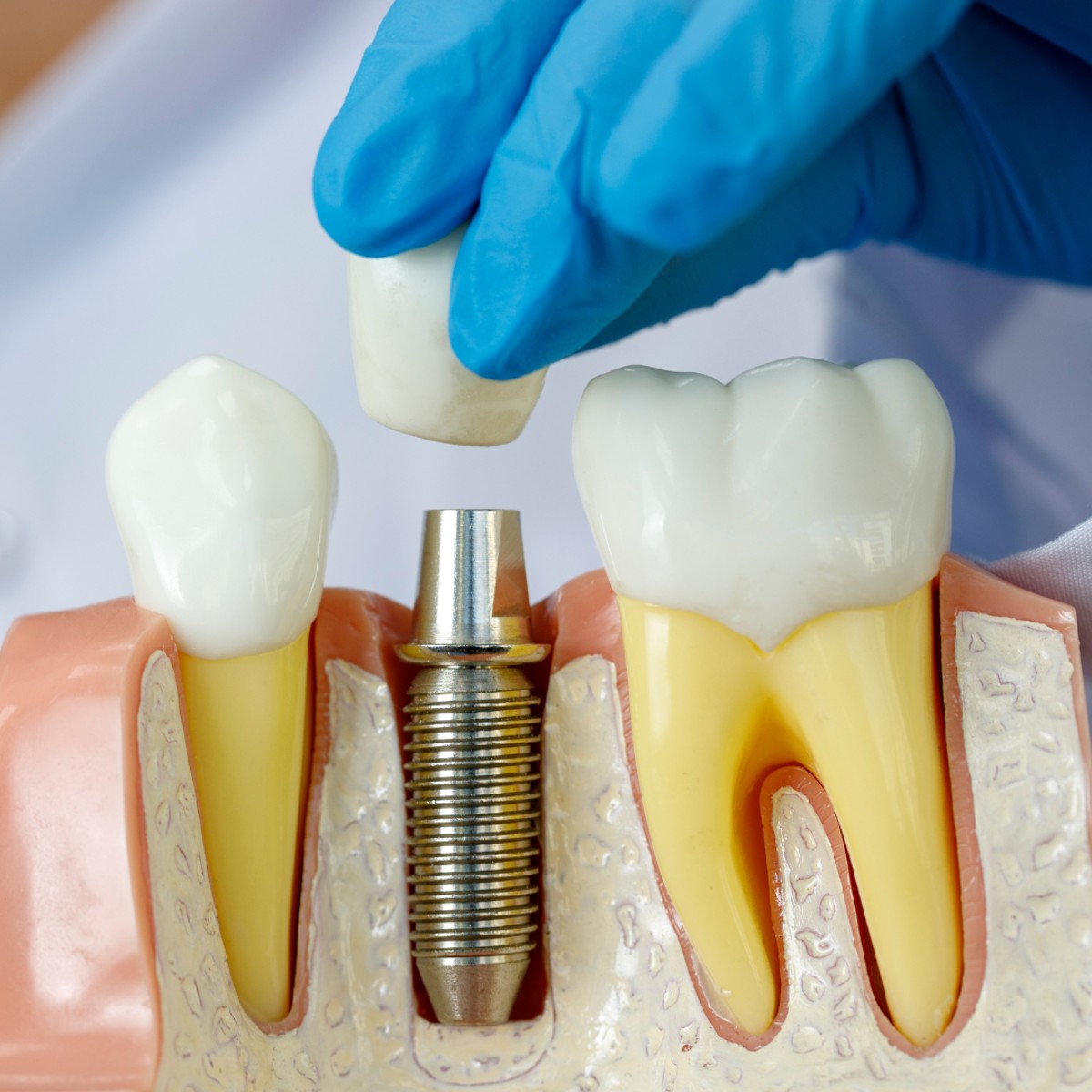 All-on-4 Dental Implants: Mexico vs. USA - Comprehensive Guide