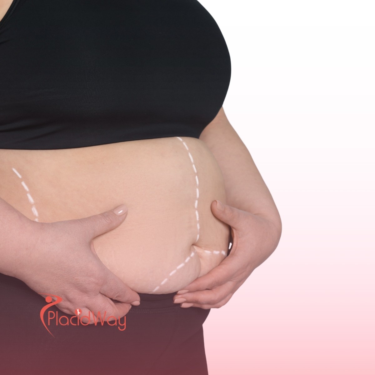 Bariatric Surgery in Turkey: Life-Changing Weight Loss Surgery for Qatar Patients with Type 2 Diabetes