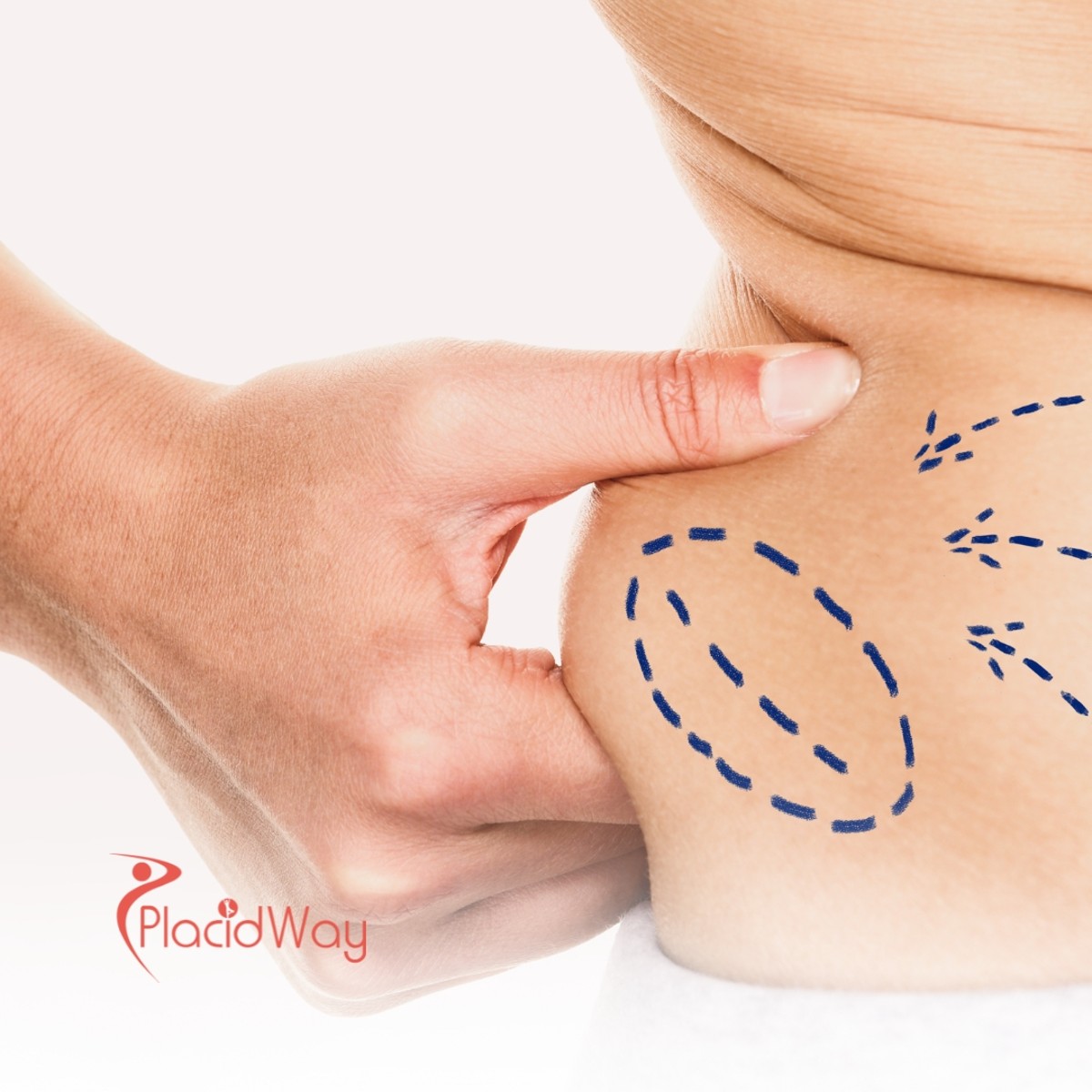 Why Mexicali, Mexico is the Top Choice for Affordable Liposuction for Arizona Residents