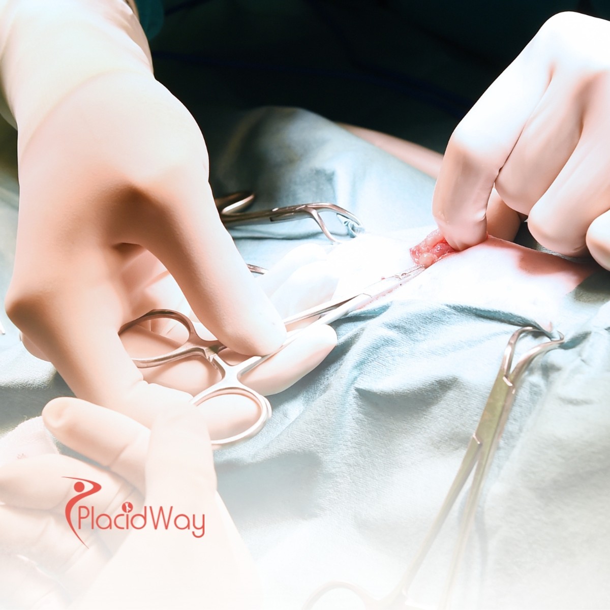 Penile Surgery in Germany: High-Quality Urology Services for Middle Eastern Men with Erectile Dysfunction