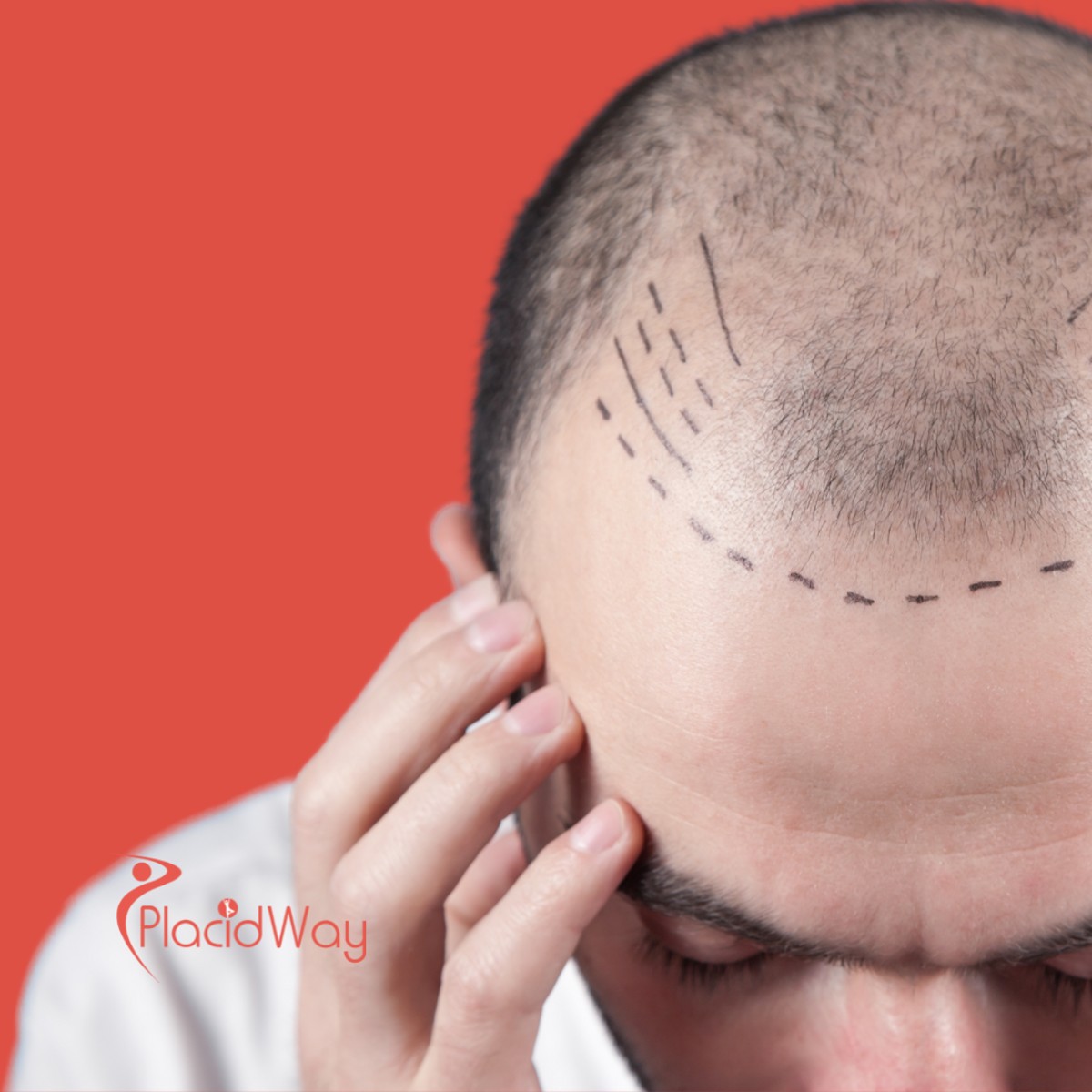 Hair Transplants in Turkey: Affordable Hair Restoration for Bahrain Men with Male Pattern Baldness