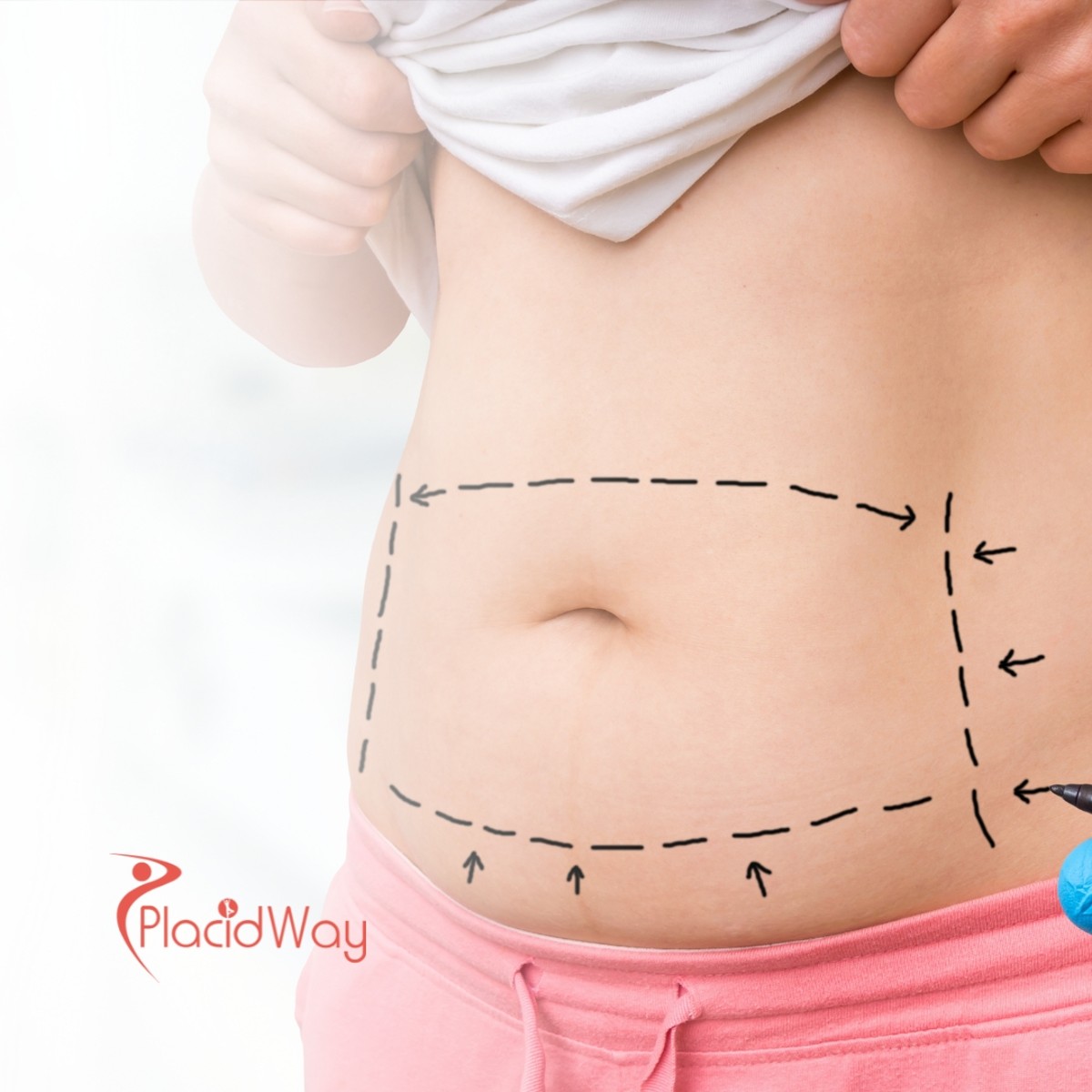 Liposuction in Colombia: Why Bahamian Patients Choose Colombia for Body Contouring
