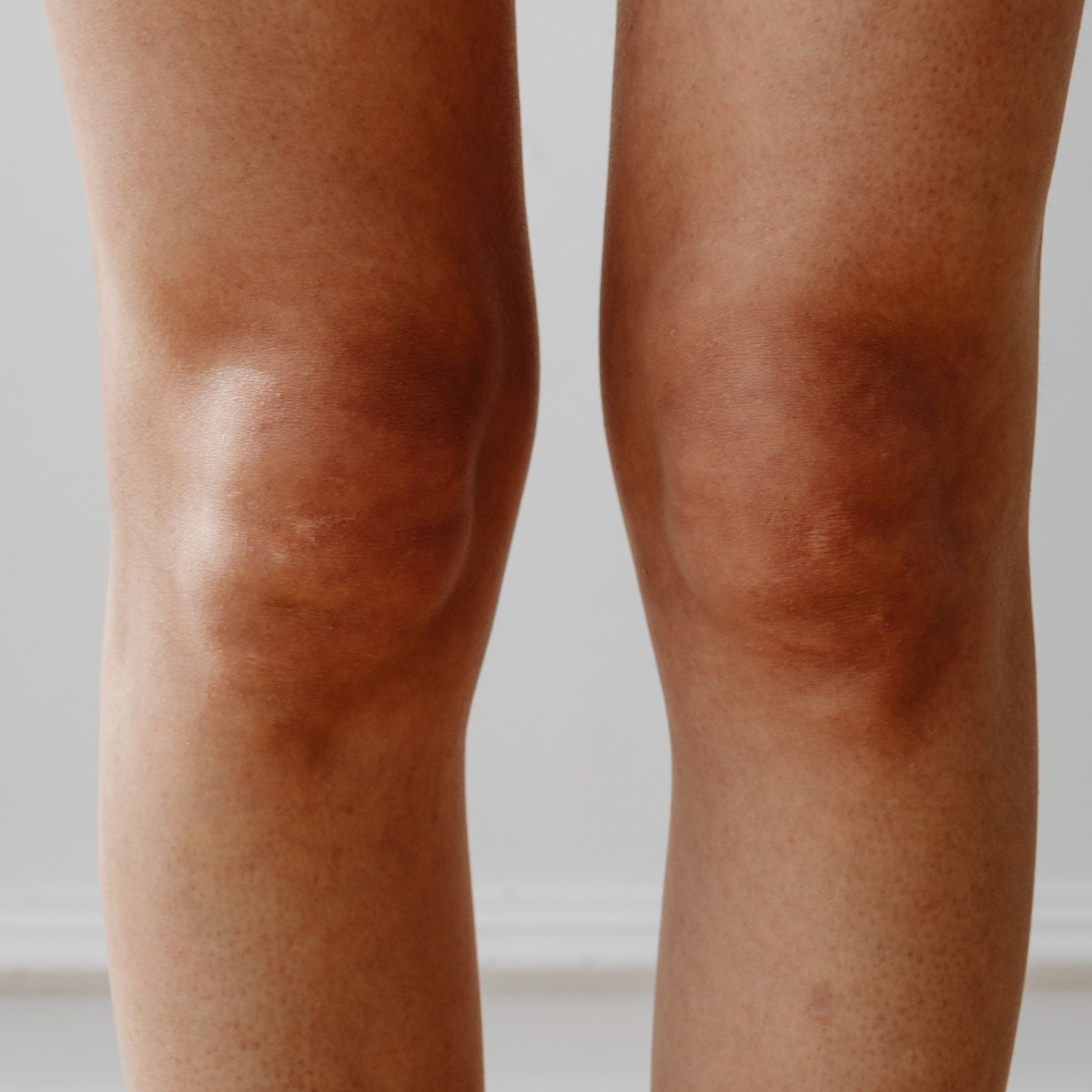 Bow Leg & Knock Knee Correction in Turkey for Kuwaiti Patients – Perfect Alignment Results