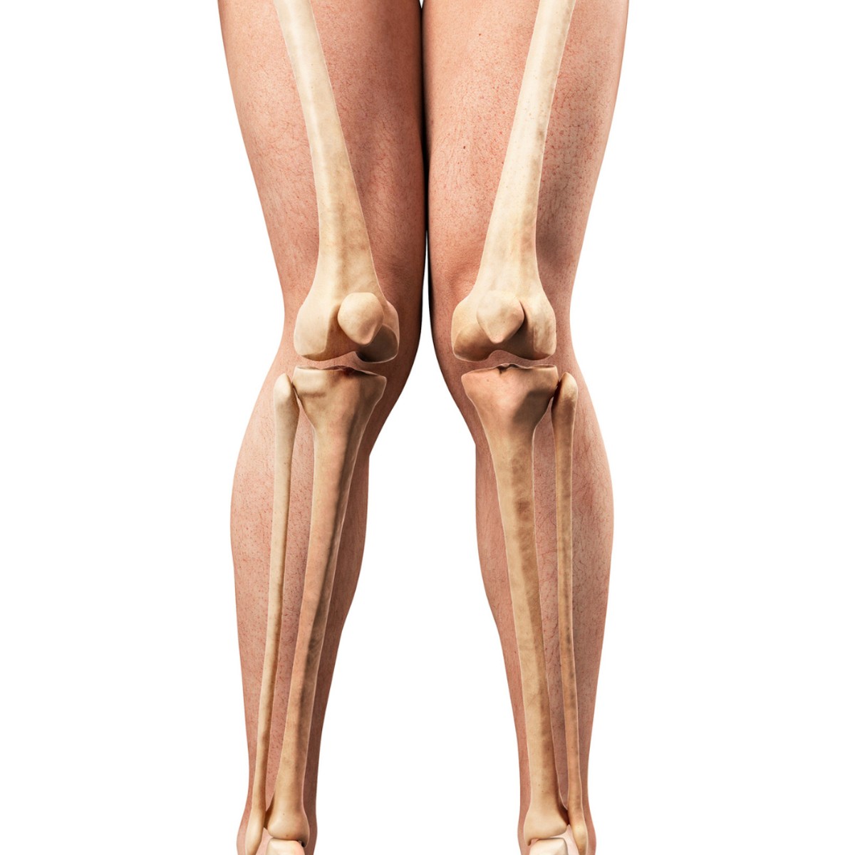 Bow Leg & Knock Knee Correction in Turkey for Nigerians – Transform Your Legs