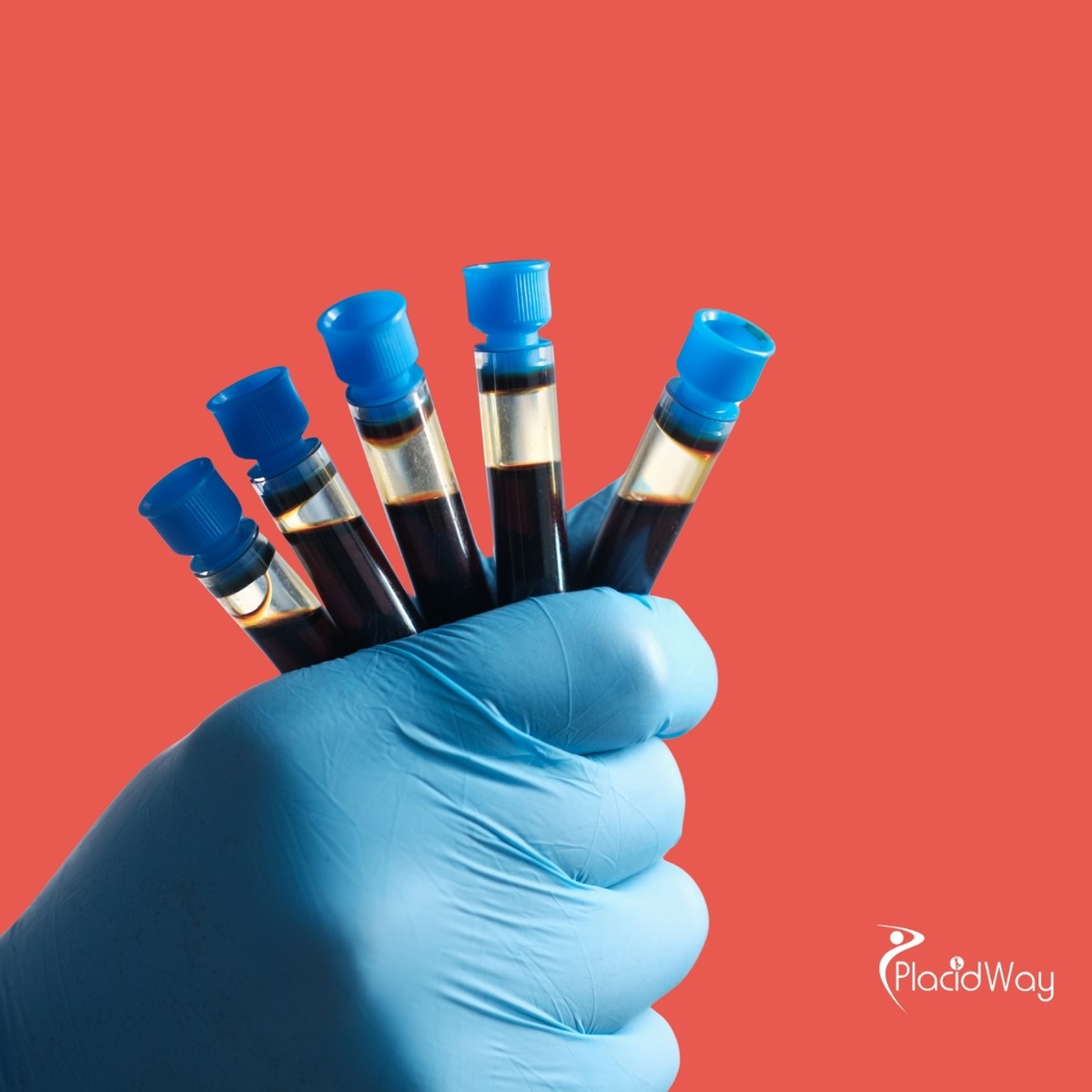 استعادة القوة والعافية: لماذا يختار المرضى النيجيريون الإمارات العربية المتحدة للعلاج بالخلايا الجذعية PRP