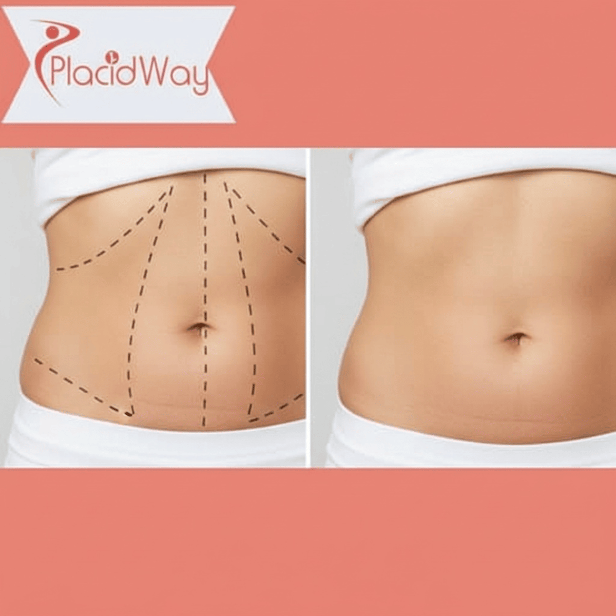 Tummy Tuck Surgery in Turkey for Adelaide Patients After Weight Loss 