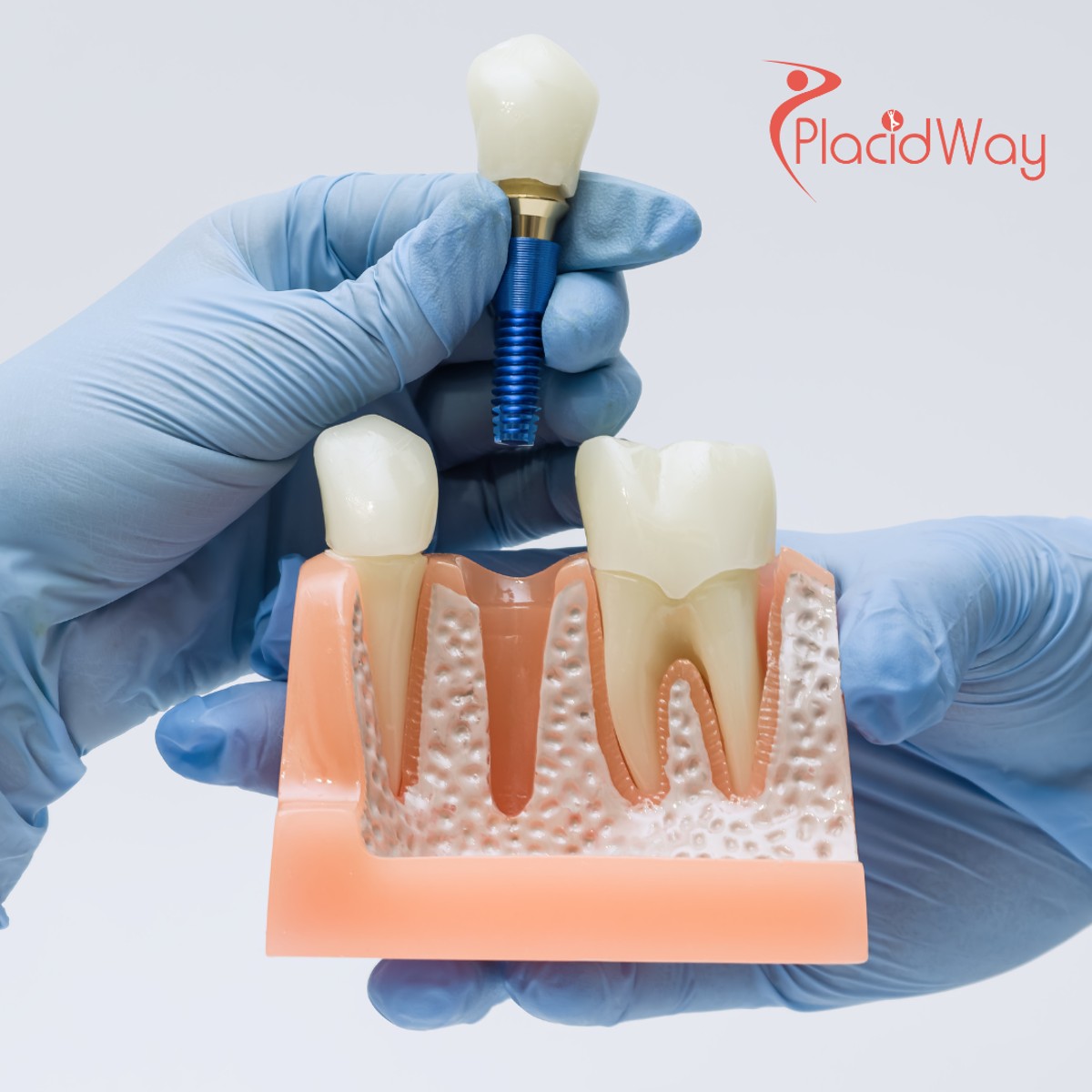 Full Mouth Restoration in Mexico for Edmonton Patients