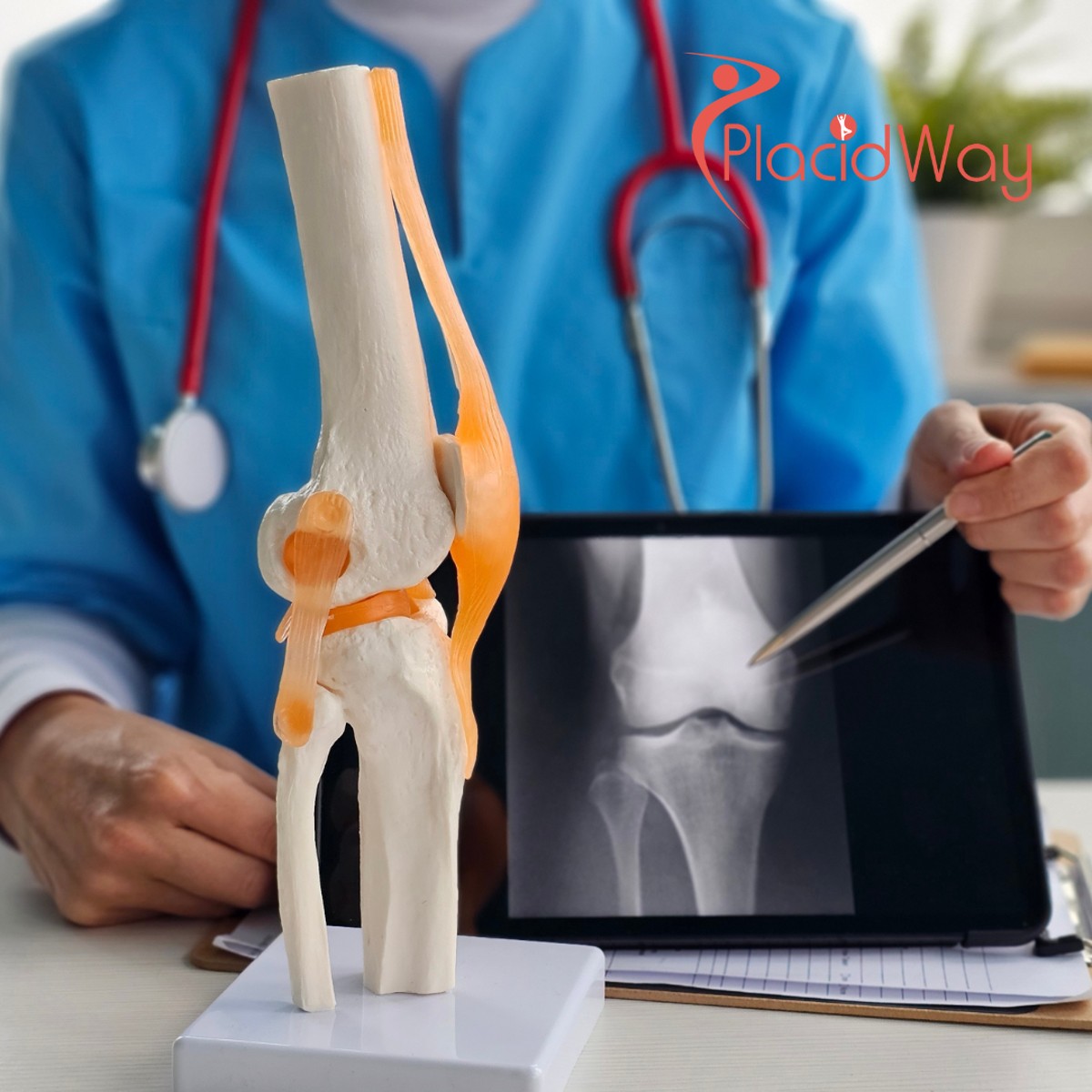 Knee Replacement Surgery in India for Bangladeshi Patients