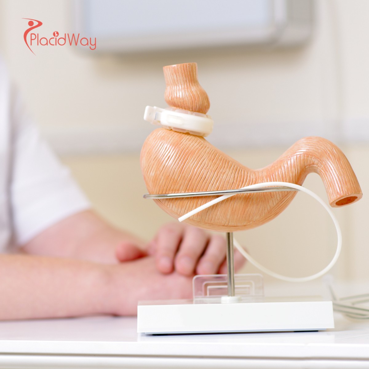 Cirugía bariátrica de revisión en Turquía para pacientes que reinician su proceso de pérdida de peso.