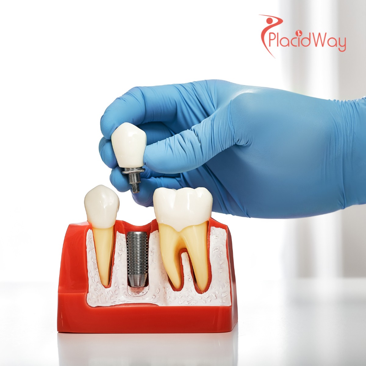 A Growing Trend: Russian Patients Choose Georgia for World-Class Dental Implant Procedures