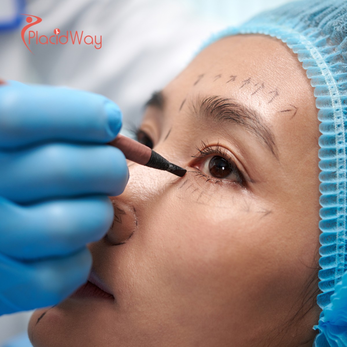 South Korea’s Blepharoplasty Boom: How Seoul Clinics are Redefining 