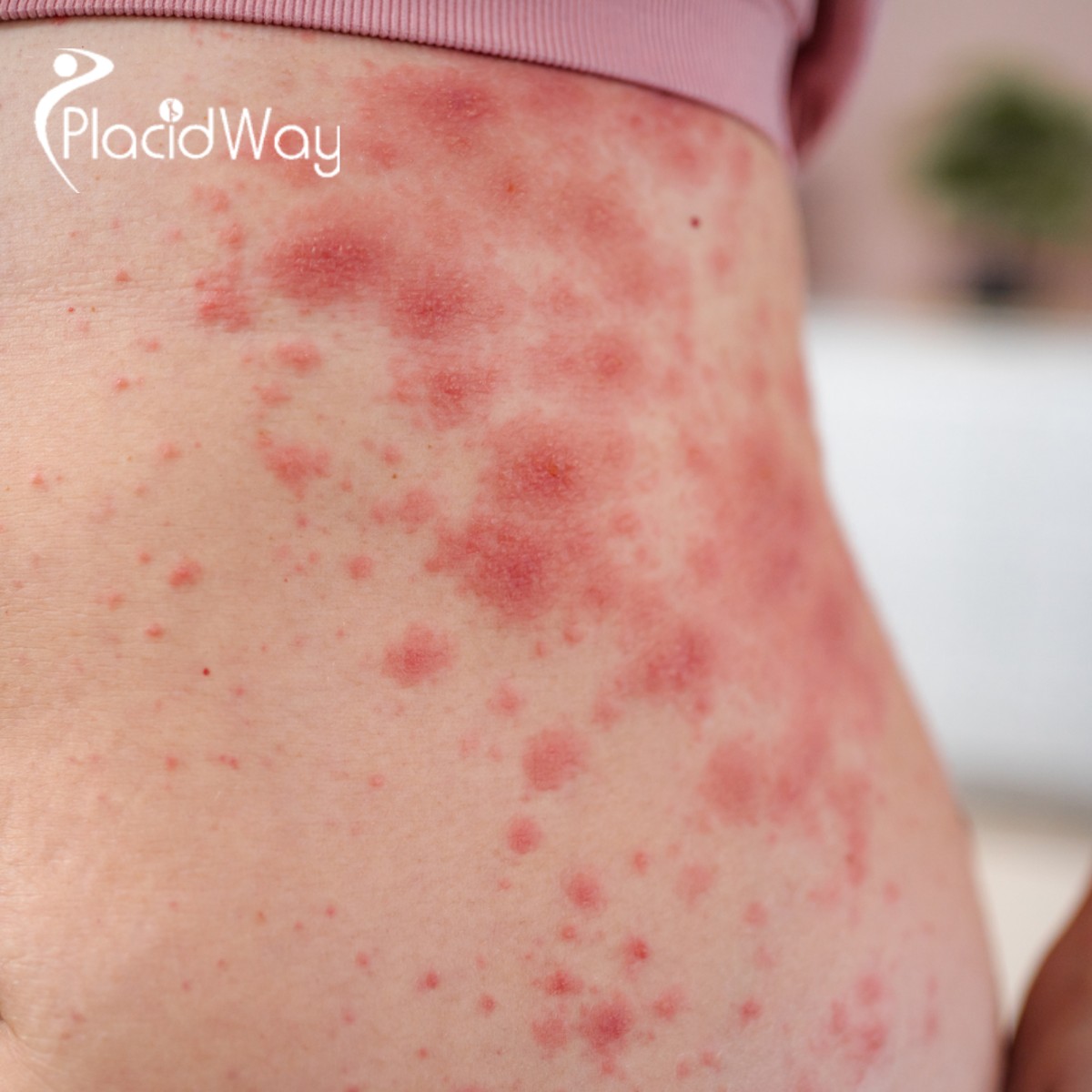 Lupus No More: How Canadians Are Reversing Symptoms with Stem Cells in Guadalajara