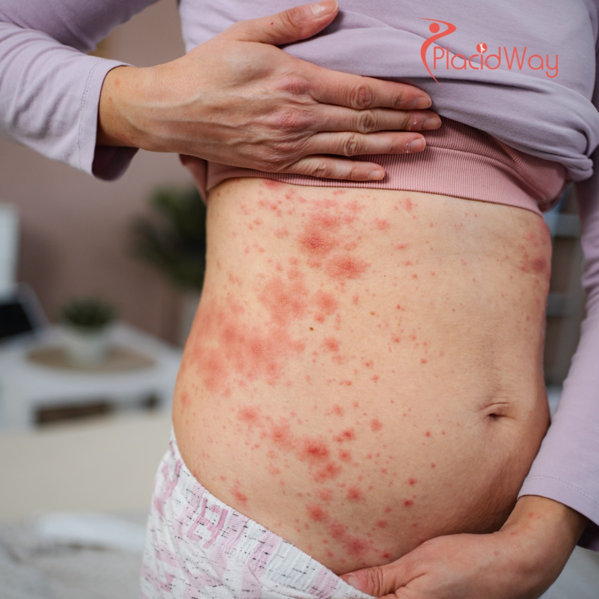 Clear Skin Awaits: U.S. Psoriasis Patients Are Finding Real Relief in Mexico’s Stem Cell Clinics!