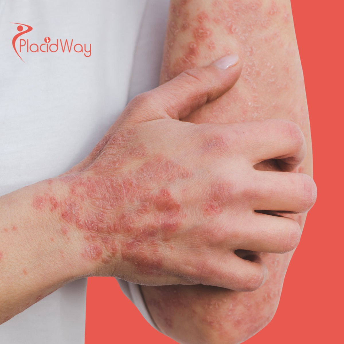 Psoriasis Doesn’t Have to Win: Why Americans Are Turning to Immune-Level Strategies in Mexico for Skin Balance