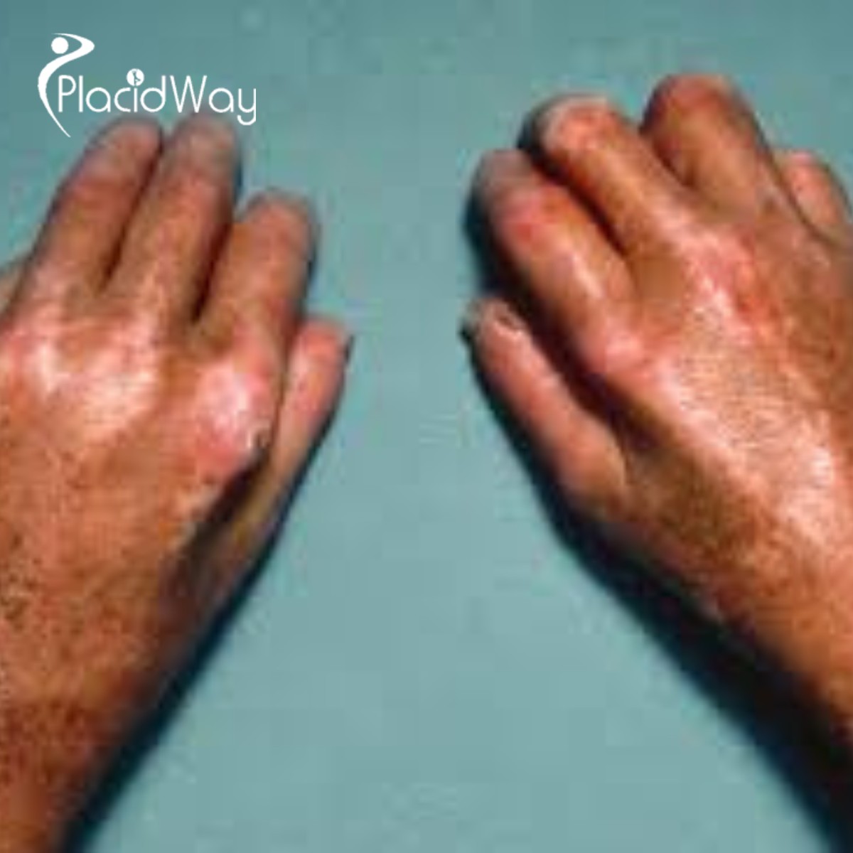 Scleroderma Doesn’t Define You: U.S. Patients Are Reclaiming Their Health with Stem Cells in Tijuana