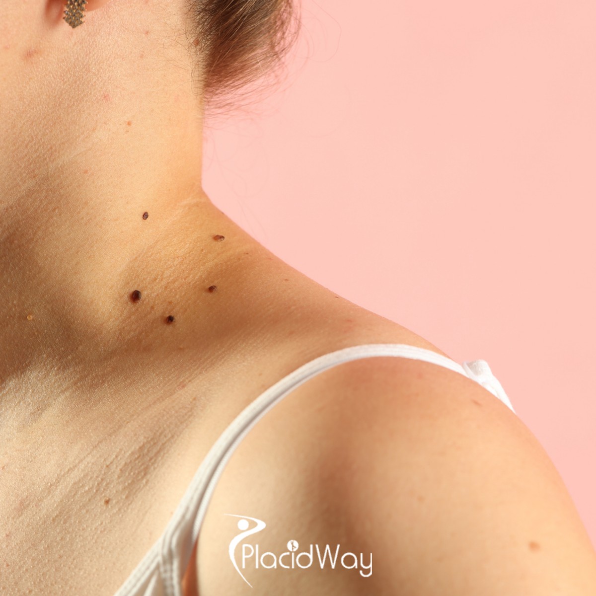 Melanoma Treatment Solutions: How U.S. Patients Are Finding New Hope in Mexico’s Clinics