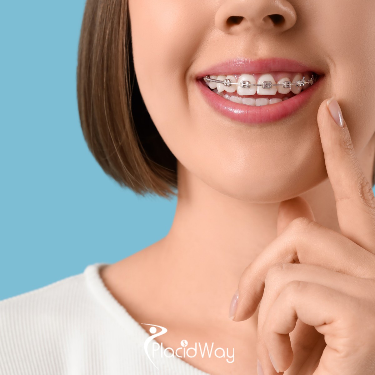 Clear Aligner Tourism: Why Bengaluru is Emerging as the Preferred Hub for Western Digital Nomads Seeking High-Tech Orthodontic Correction