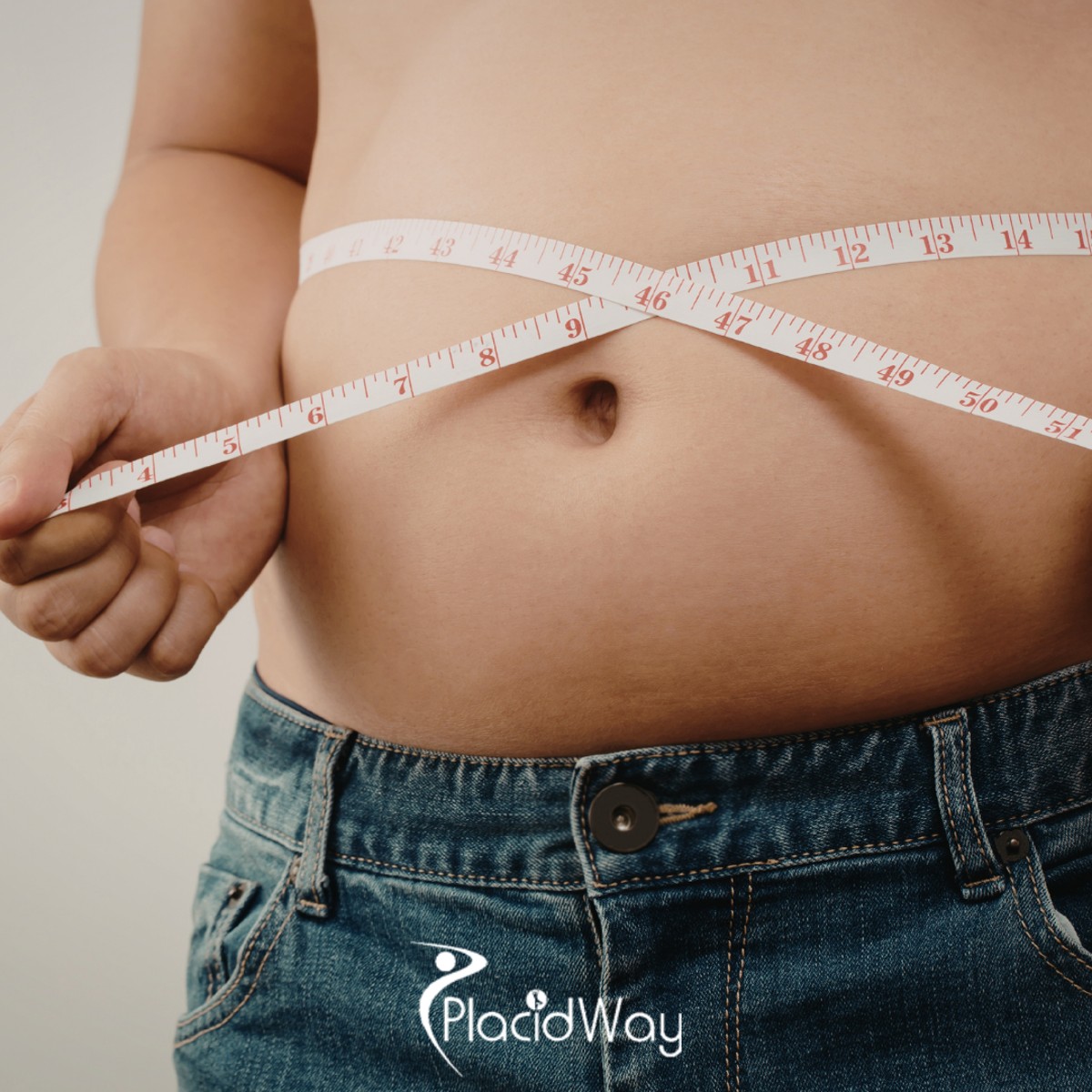 7 Reasons US Patients Choose Single-Incision Gastric Sleeve in Tijuana for Faster Recovery