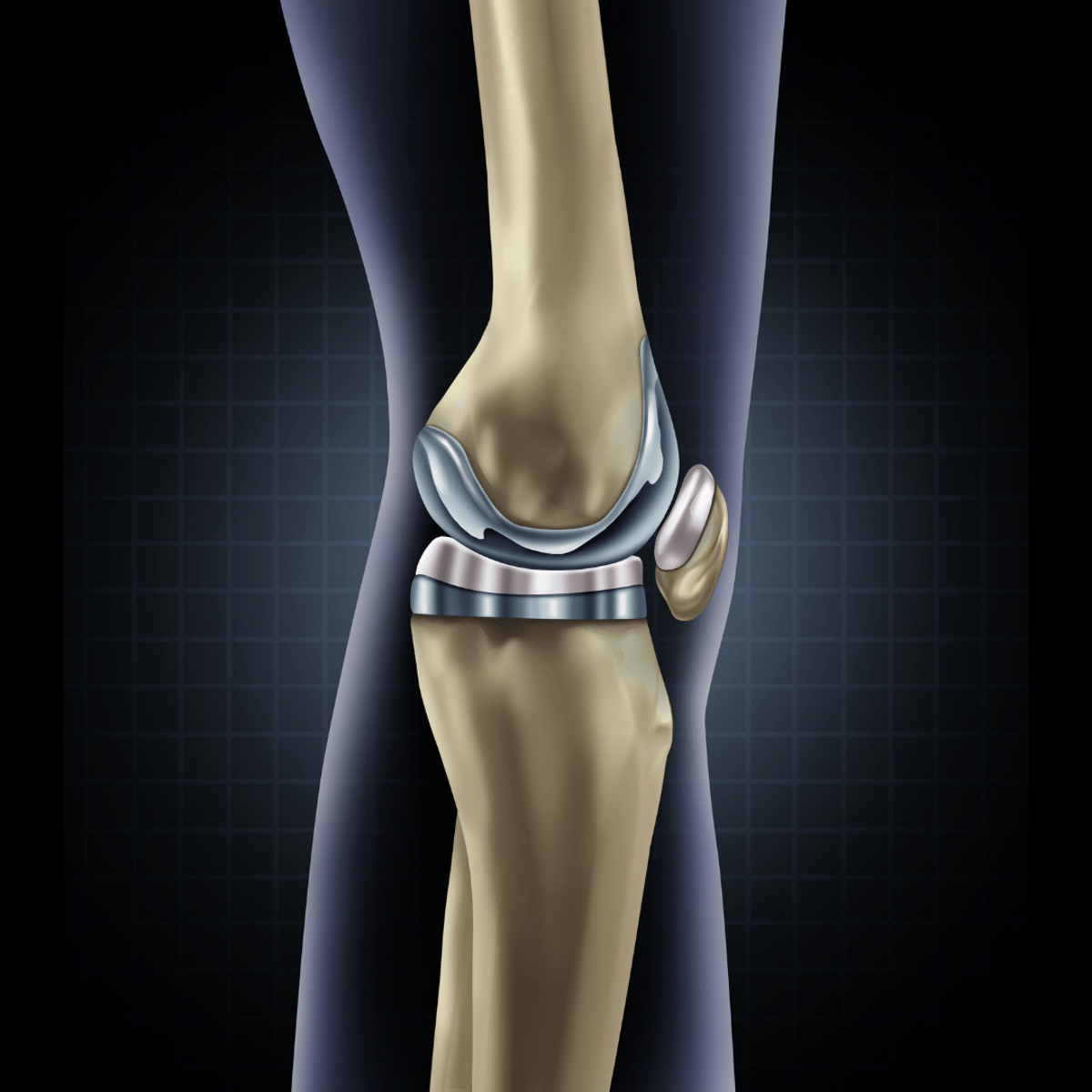 Total Knee Replacement Cost in Turkey and Clinics