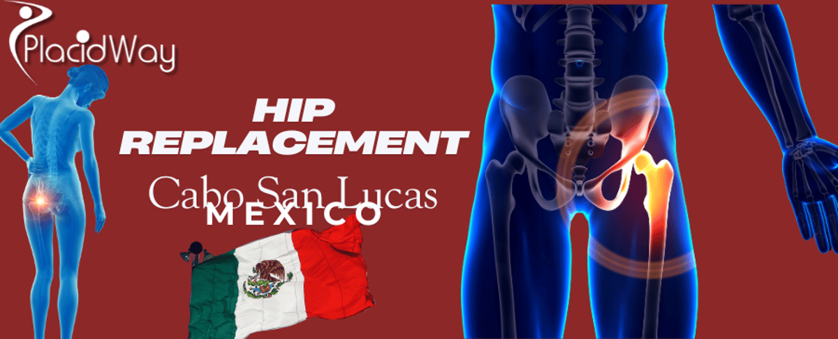 Hip Replacement in Cabo San Lucas, Mexico