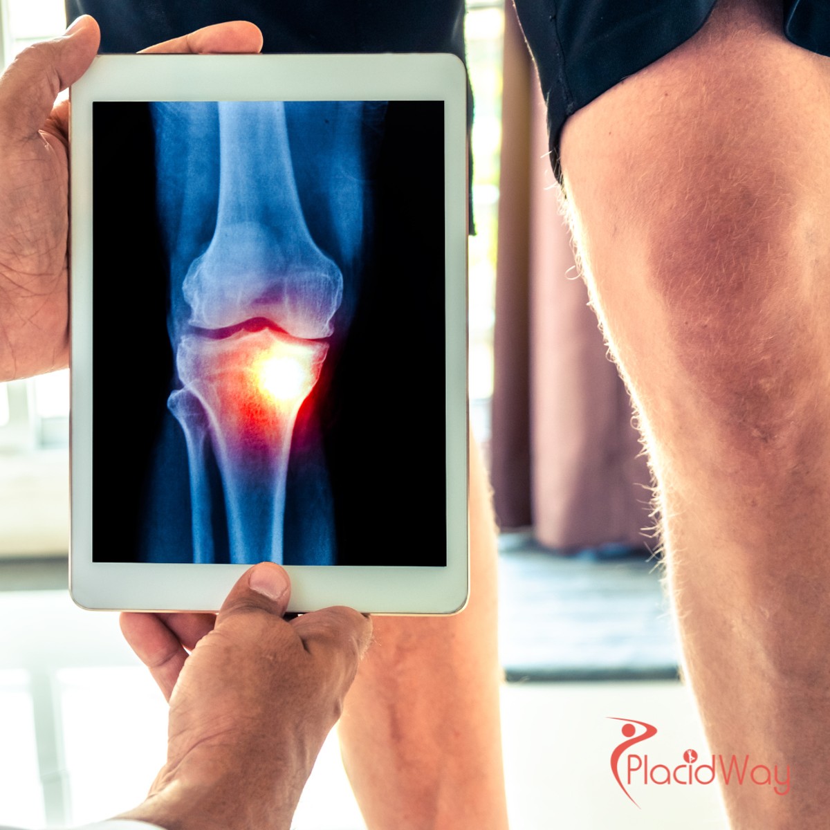 Knee Replacement Surgery in Turkey: Restore Mobility with High-Quality Treatment for Australian Tourists
