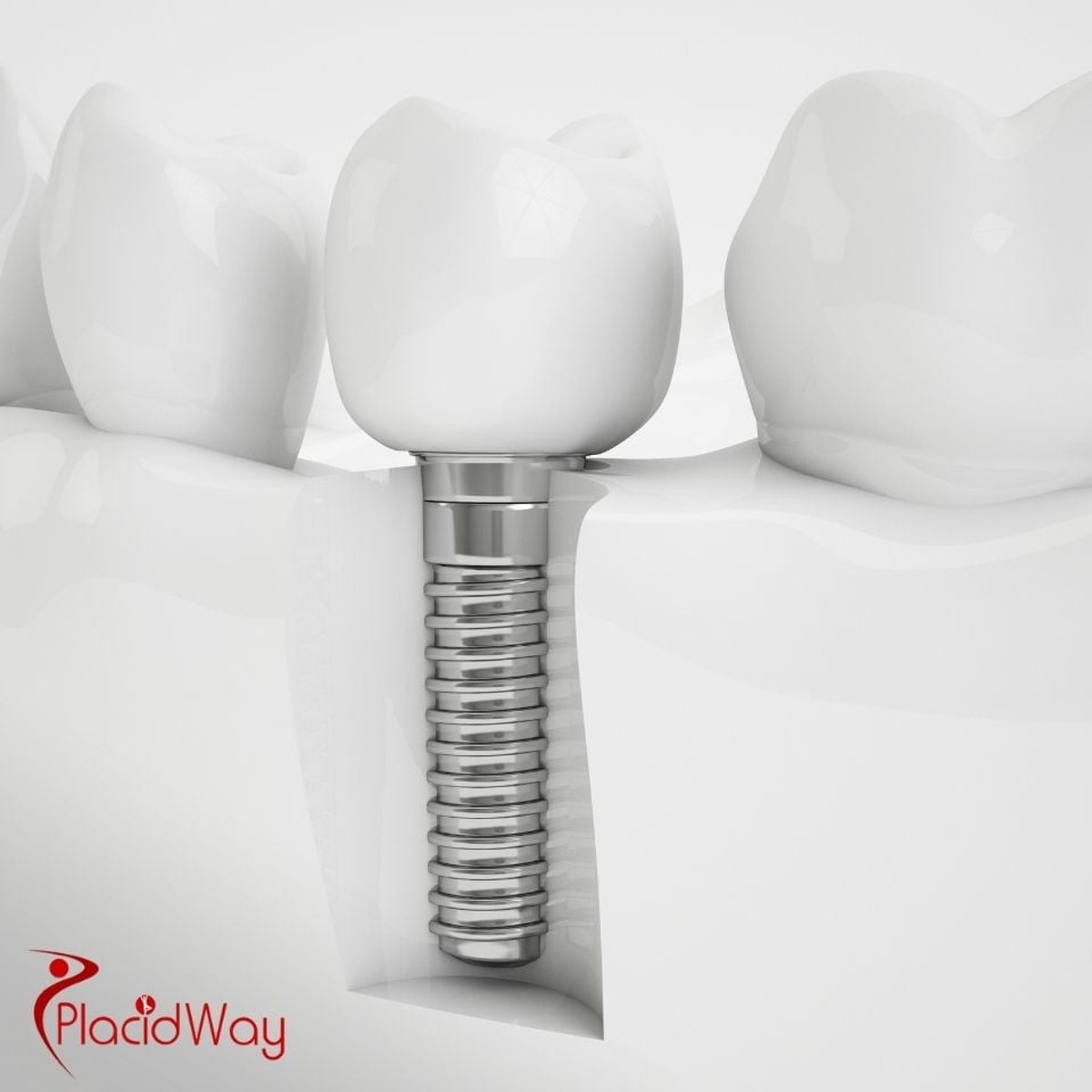 Dental Implants in Turkey: Why German Patients Choose All-on-4 Implants for a Full Smile Restoration