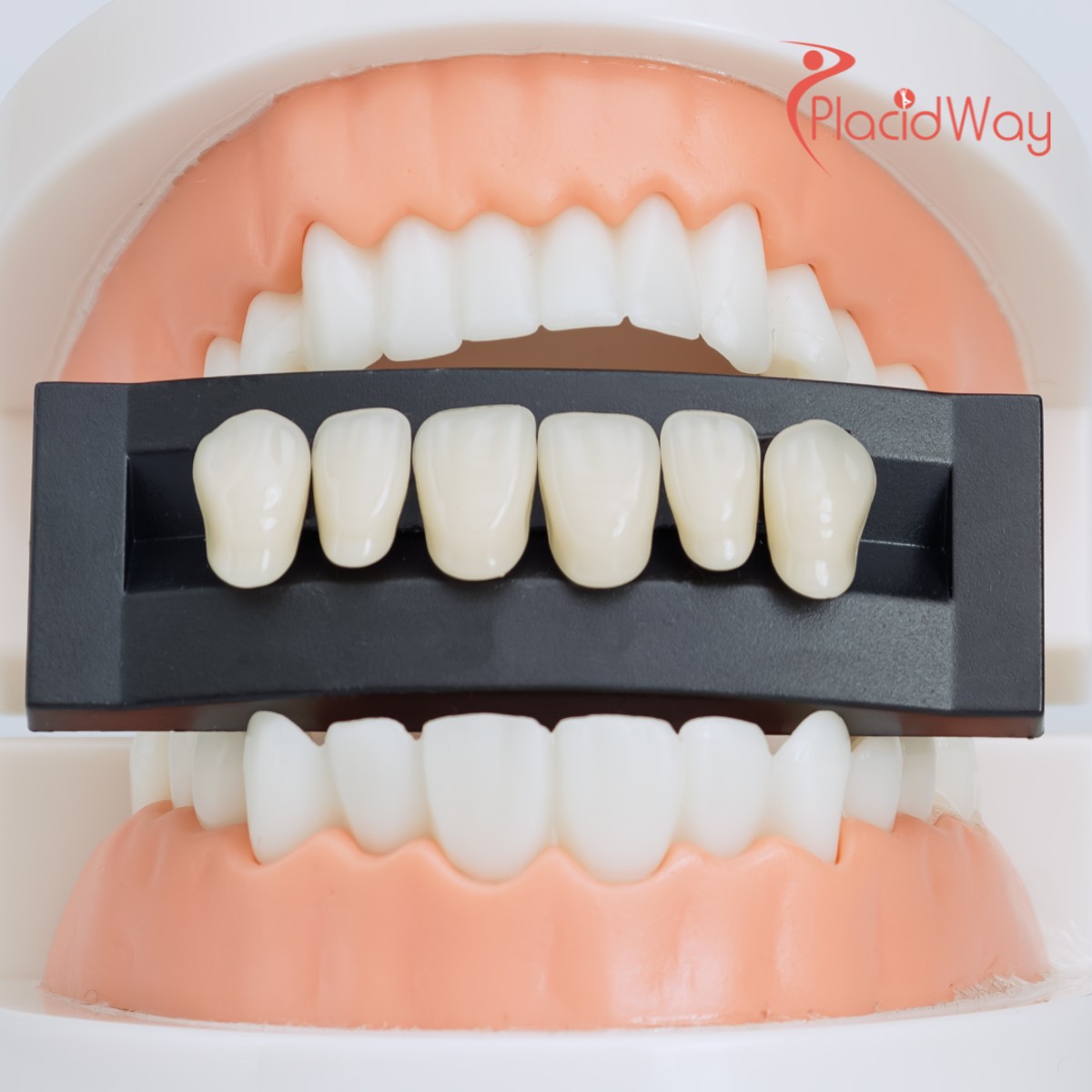 Why Kiwis are Choosing Thailand for Dental Veneers: A Comprehensive Guide