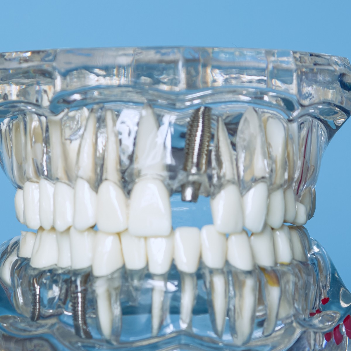 Dental Crowns in Los Algodones, Mexico: Top Affordable Clinics for Californians