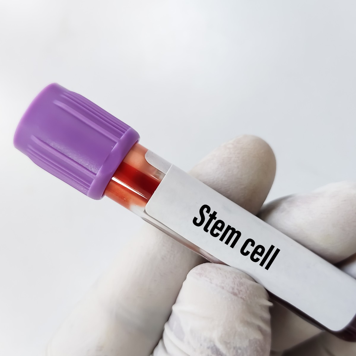 How Much Does Stem Cell Therapy Cost? A Global Comparison of Treatment Prices