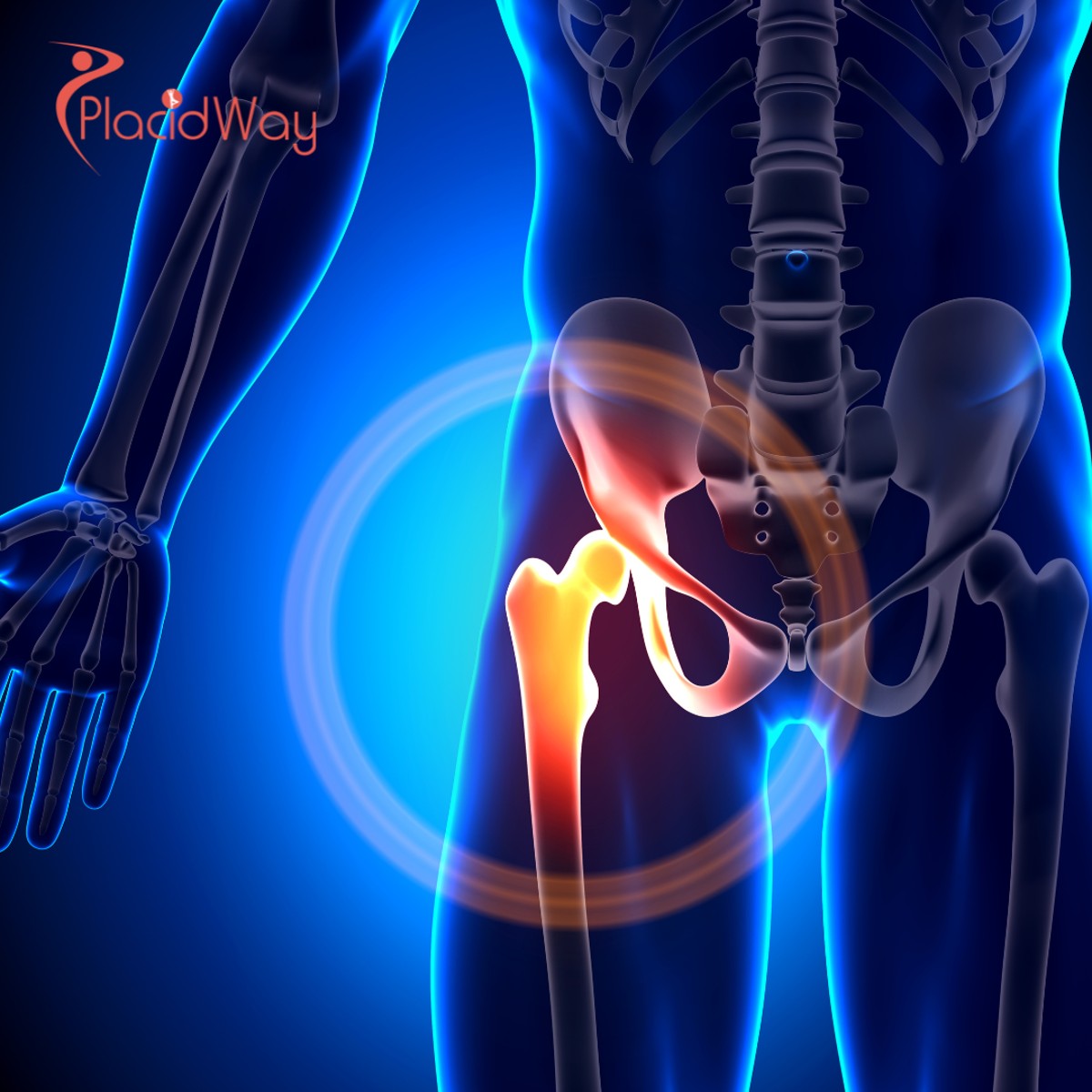 Hip Stem Cell Therapy in Mexico: The Definitive Guide for Medical Tourists