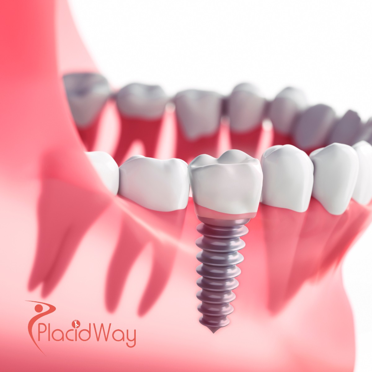 Dental Implants in Mexico for Toronto Patients Facing High Dental Costs