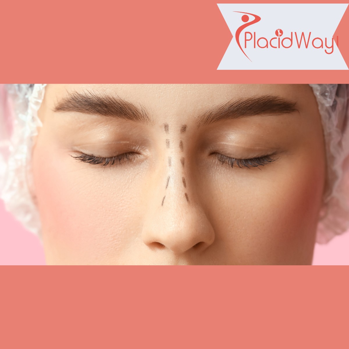 Rhinoplasty (Nose Surgery) in Turkey for Manchester Patients