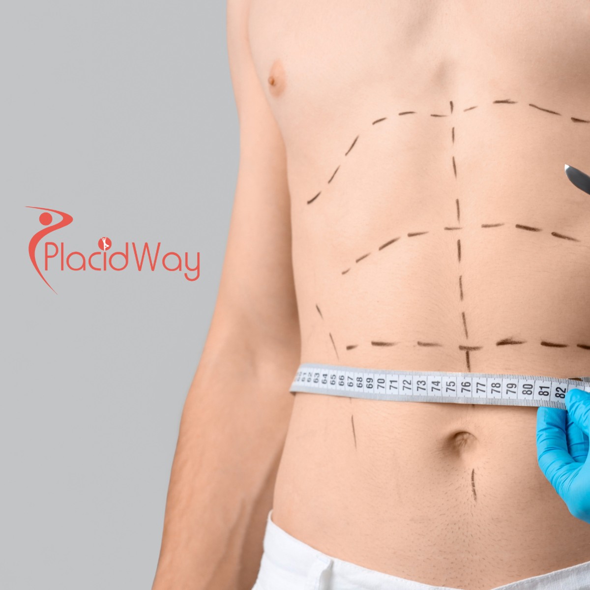 Abdominoplasty (Tummy Tuck) in Turkey for Stuttgart Patients Following Weight Loss