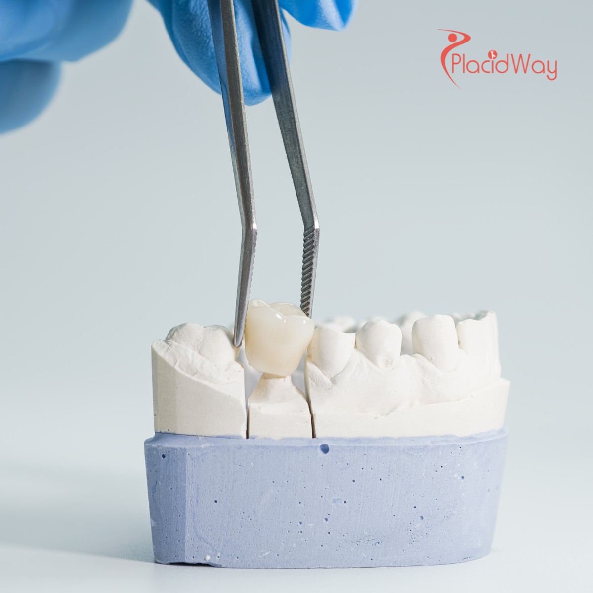 Dental Crown and Bridge Treatment in Mexico for U.S. Patients