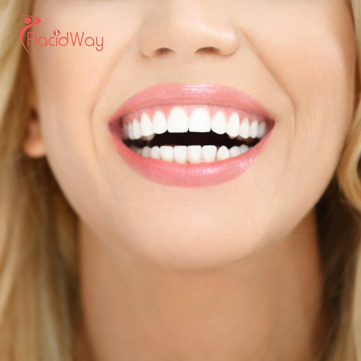 Cross-Border Convenience: Why Slovenian Patients are Flocking to Croatia for Advanced Same-Day Smile Makeovers