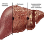 Topmost Fetal Stem Cell Therapy for Liver Cirrhosis in Kiev, Ukraine thumbnail