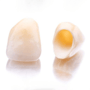 Dental Crowns in Los Algodones, Mexico thumbnail