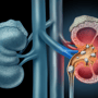 Successful Kidney Stones Surgery in Mexico thumbnail