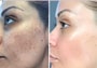 Skin Damage Treatment Program in Ukraine and Poland thumbnail