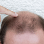 Platelet Rich Plasma for Hair Transplant in Mexico City, Mexico thumbnail