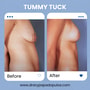 Tummy Tuck Package at Dr. Ary Papadopulos - Plastic Surgery in Mexico City, Mexico City, Mexico thumbnail