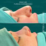 Nose Surgery Rhinoplasty special discount Package at Prof. Dr. Furkan Karabekmez Clinic | Best Plastic Surgery Ankara, ankara, Turkey thumbnail